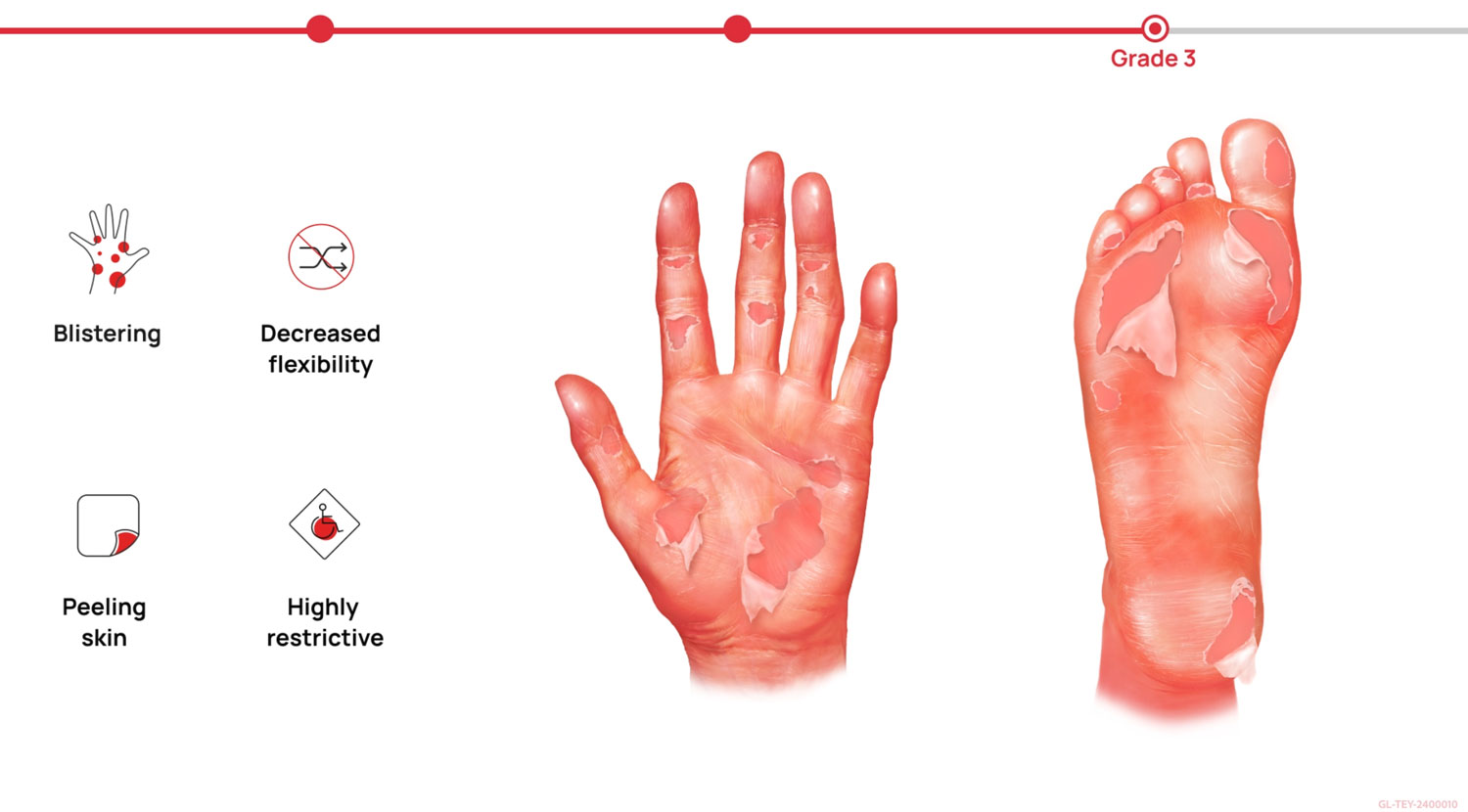 Hand-foot syndrome health awareness campaign medical illustration thumbnail