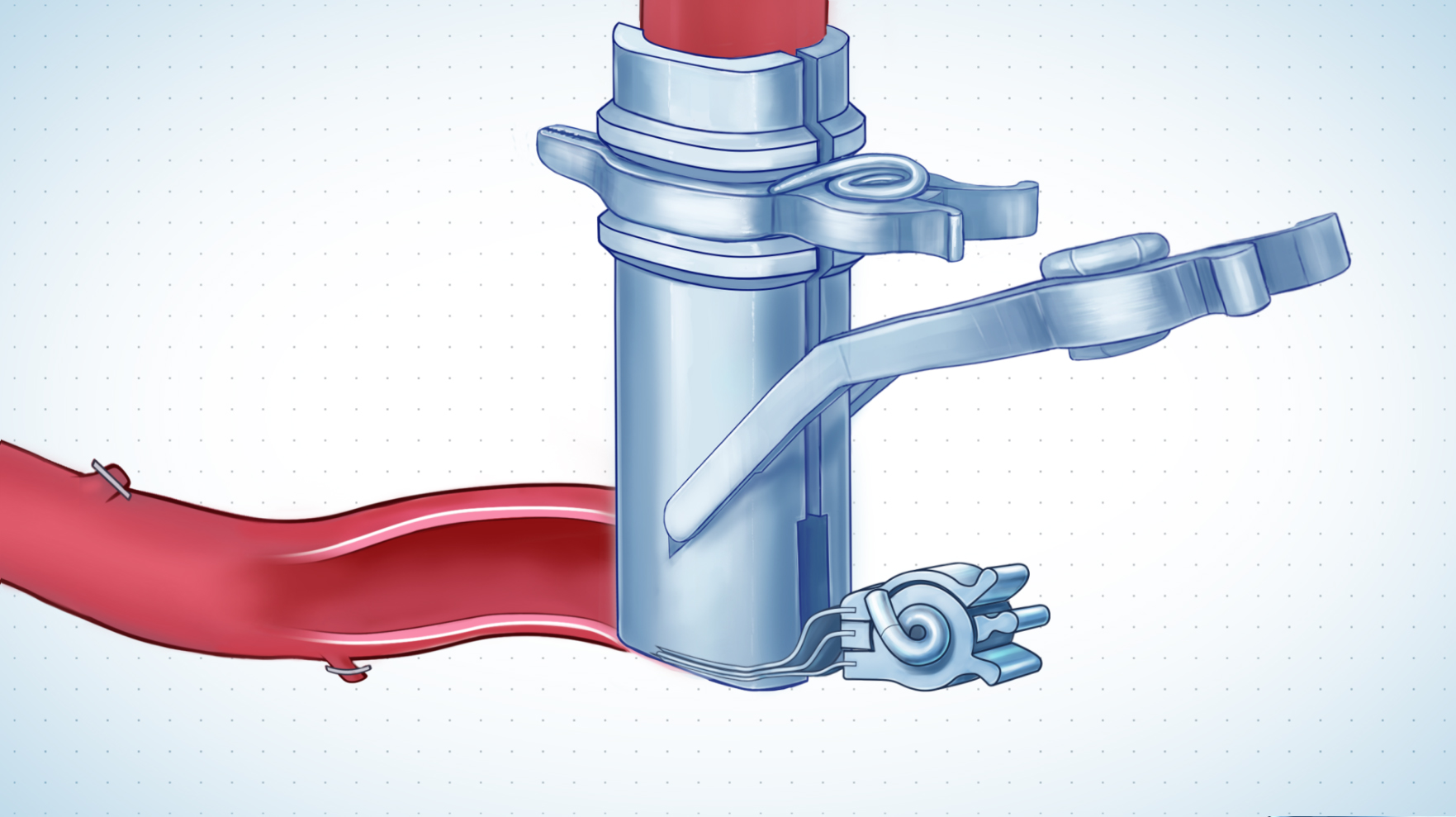 Fixator and clip placement surgical illustration – ELANA bypass procedure