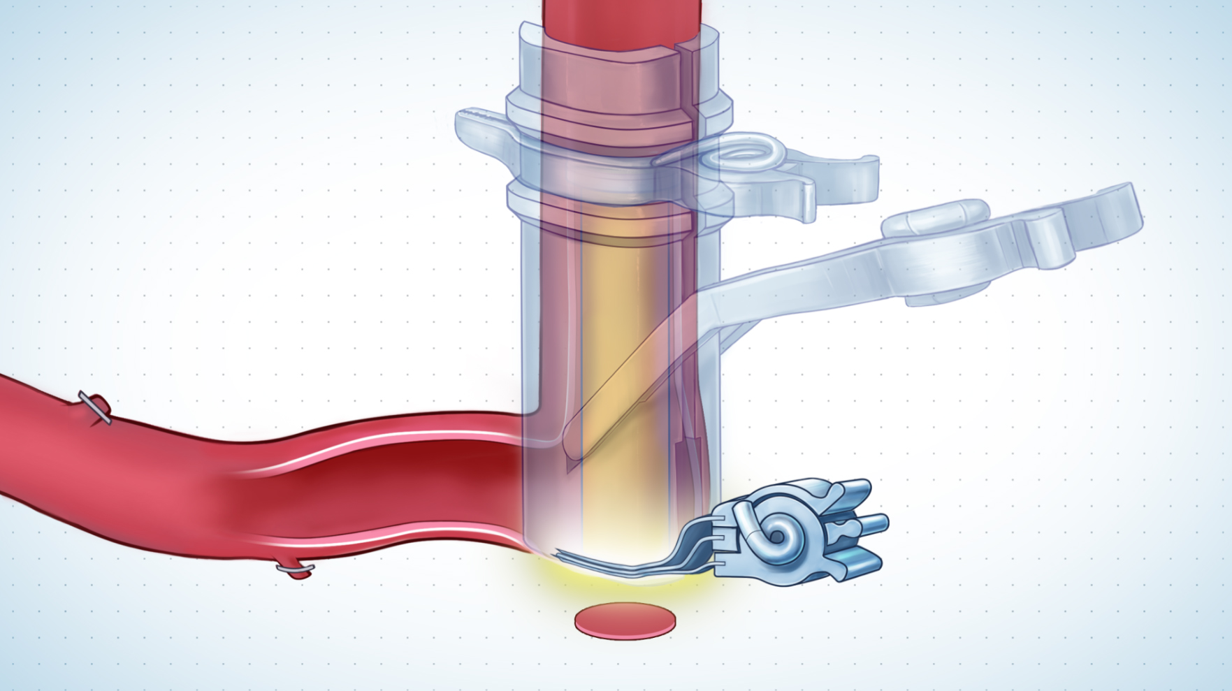 Lasering and flap retrieval from graft – ELANA coronary bypass illustration