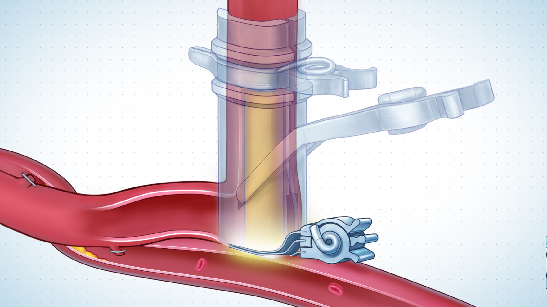 Laser application on coronary artery wall during bypass surgery illustration