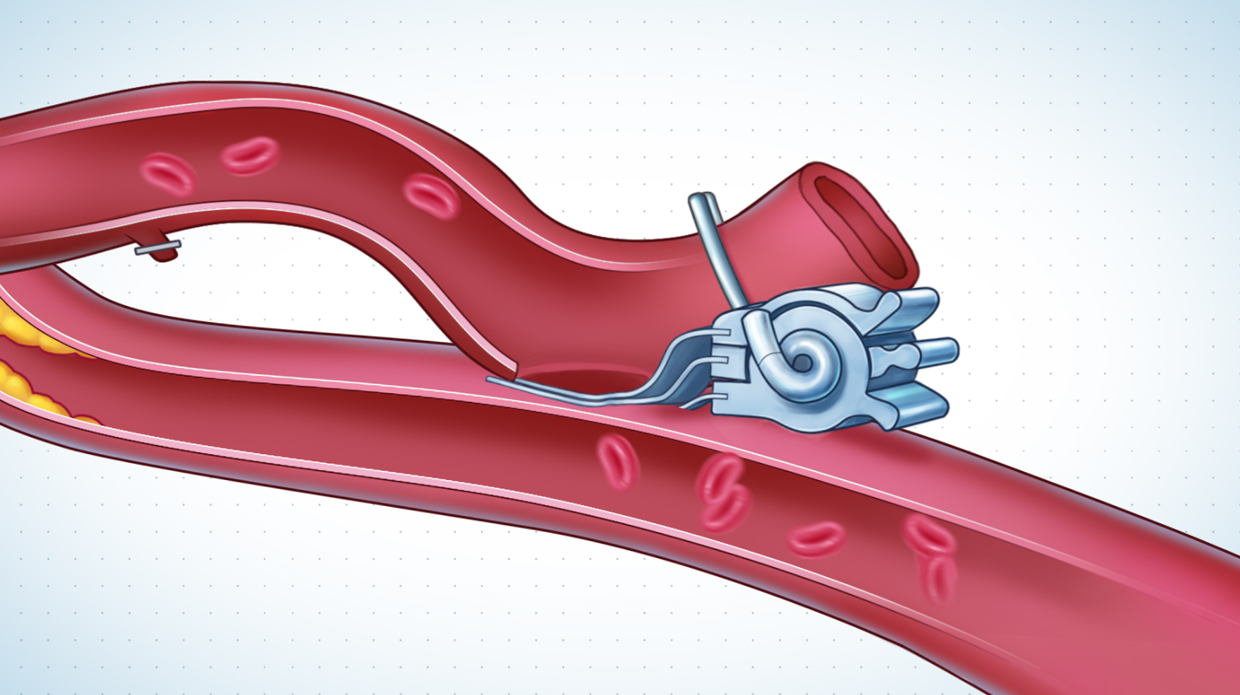 Completed coronary anastomosis using ELANA heart bypass system illustration