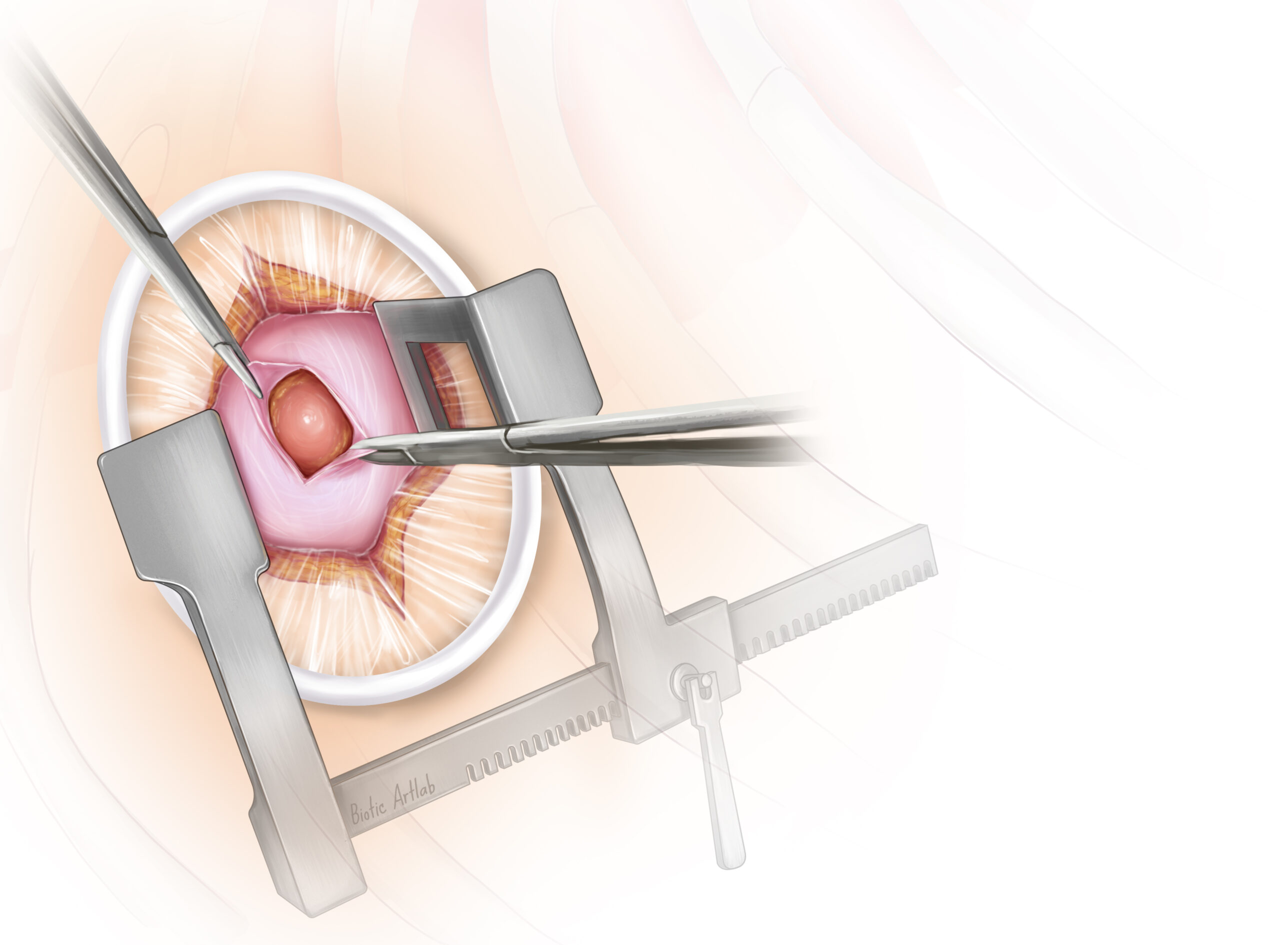 Surgical illustration of pericardium opening in Tendyne mitral valve procedure