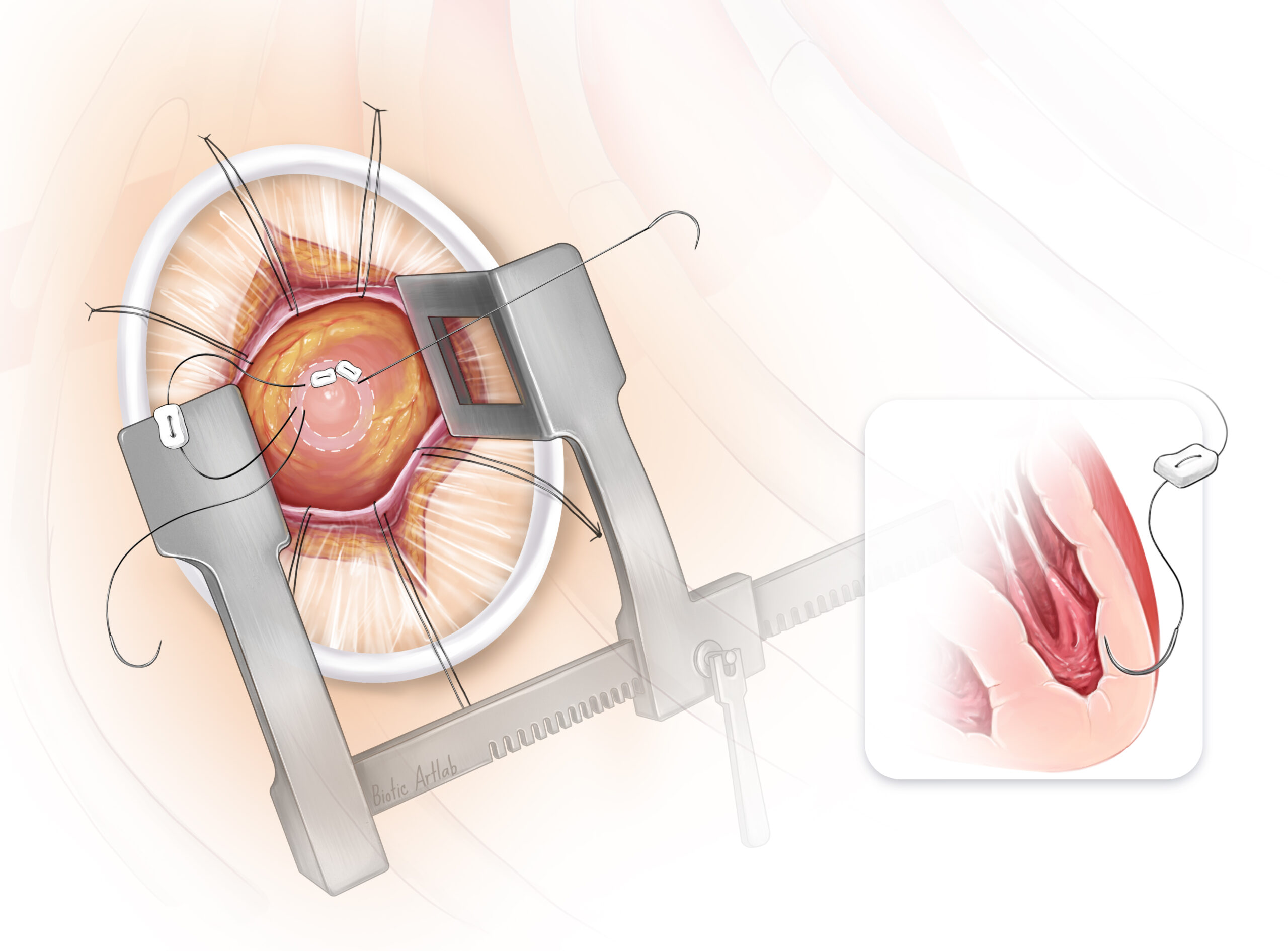 Purse-string suture placement step in transcatheter mitral valve replacement illustration