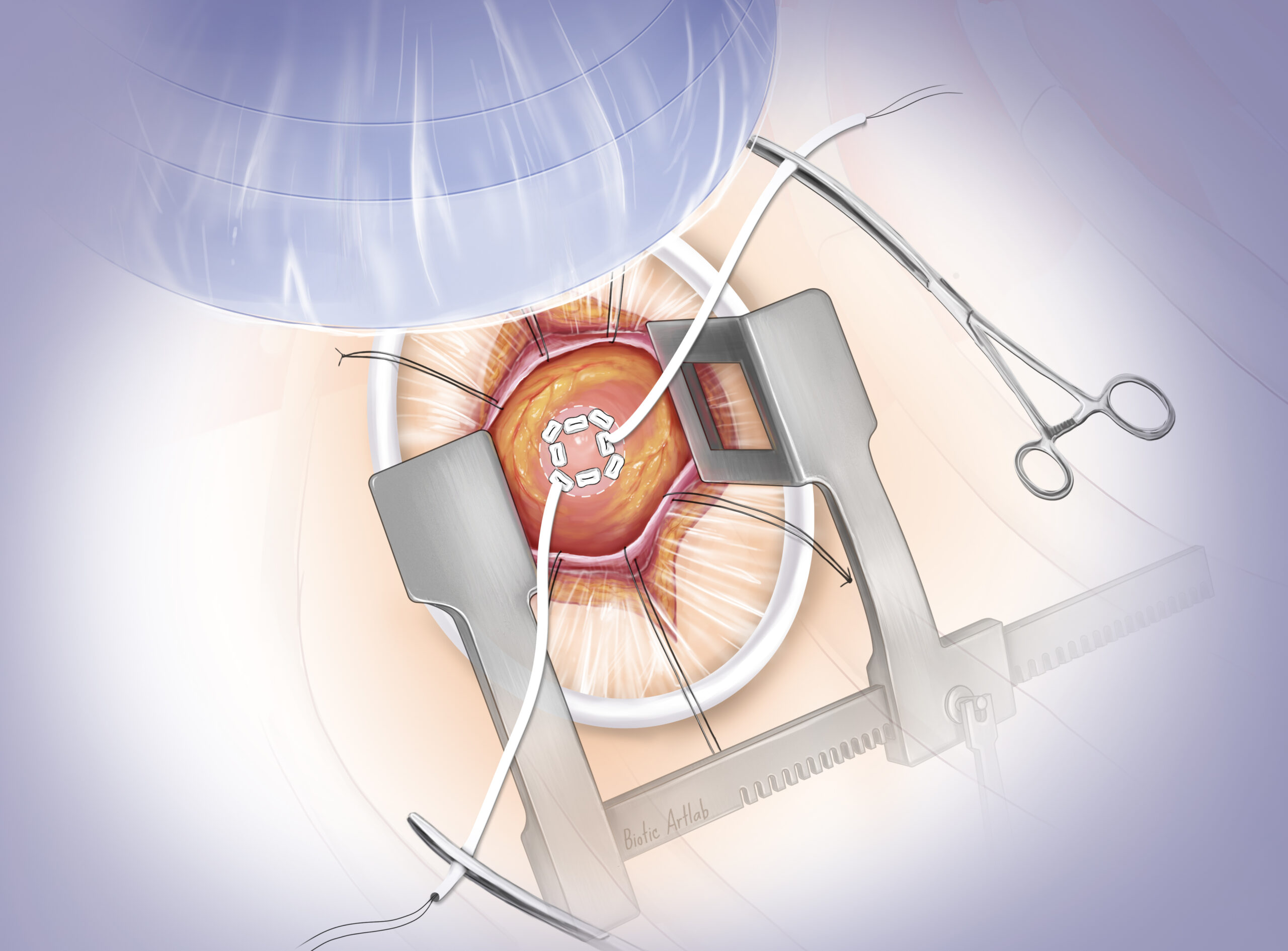 Completed purse-string suture in Tendyne TMVR procedure illustration