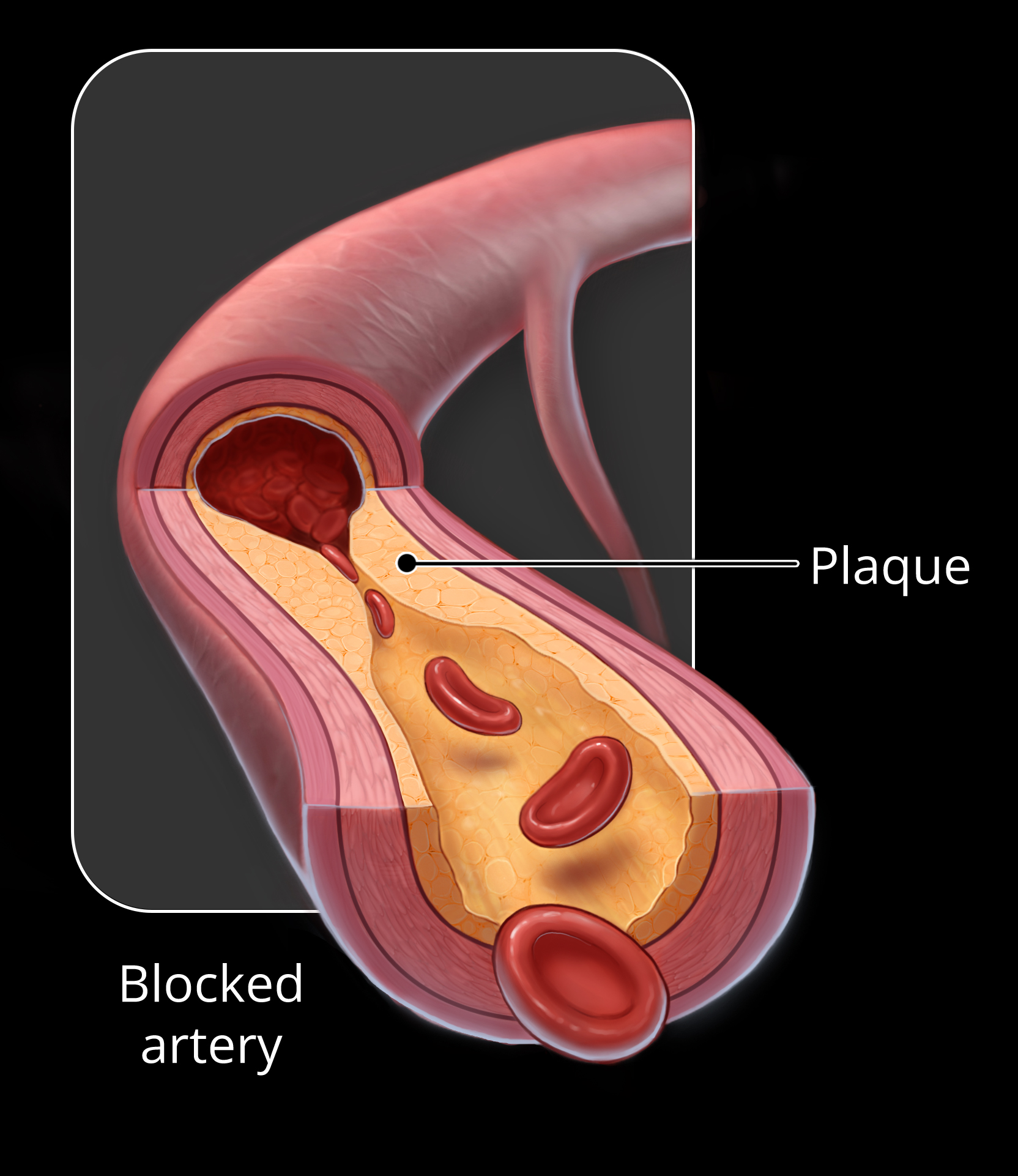 Blocked artery medical illustration for Stentit vascular device