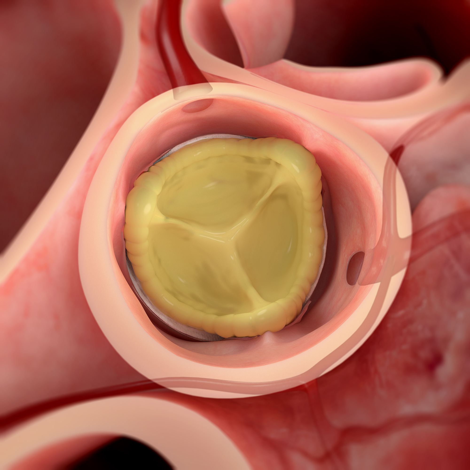 Epicmax medical device top-down view illustration
