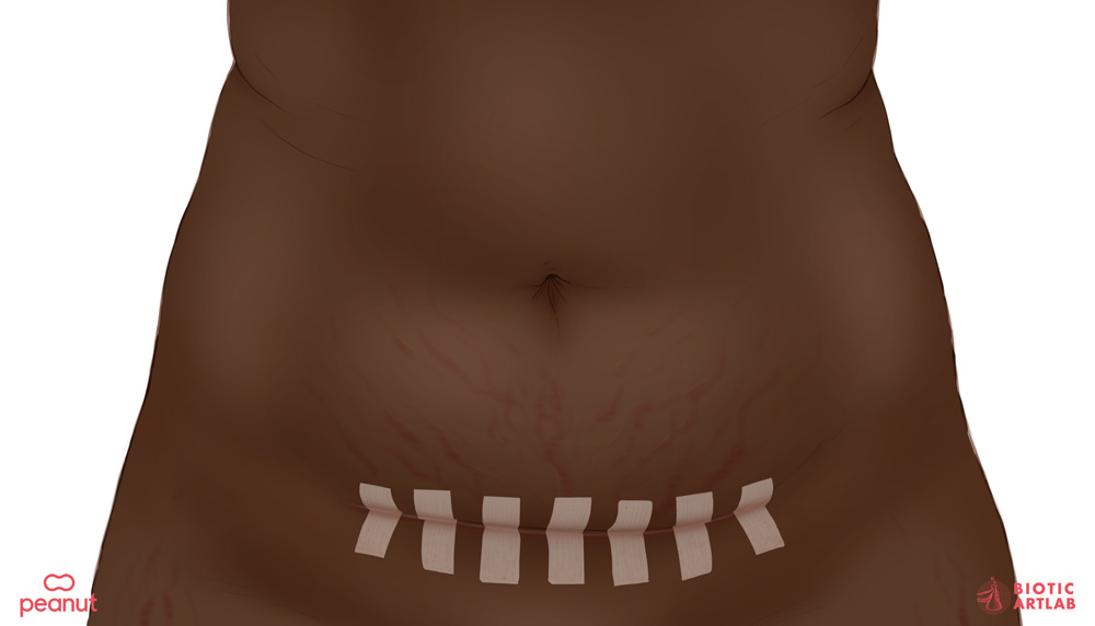 C-section scarring medical illustration for Peanut women's health app