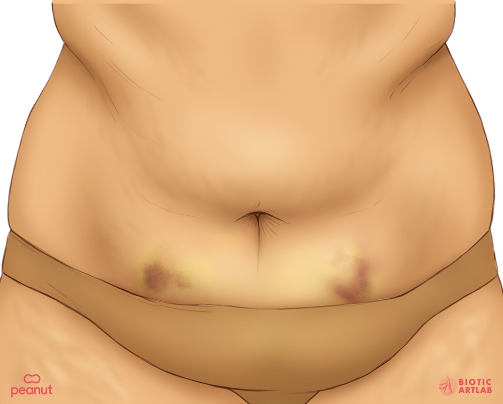 IVF injection bruising medical illustration showing diverse skin tones for Peanut app