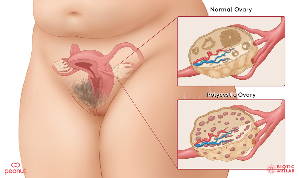 PCOS medical illustration for Peanut women's health app