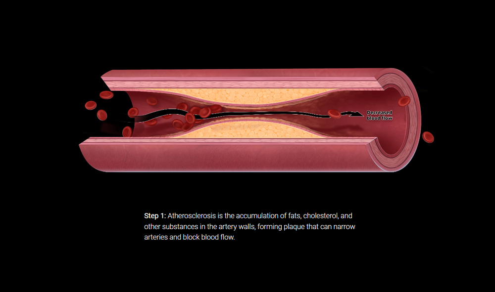 Artery anatomy medical illustration for Stentit medical device website