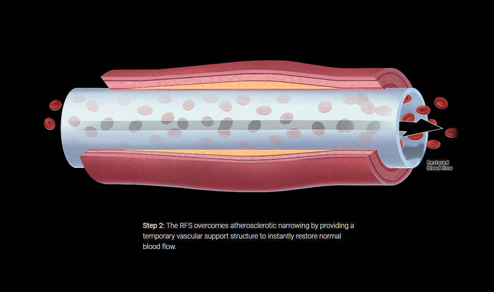 Artery cross-section illustration for Stentit vascular device website