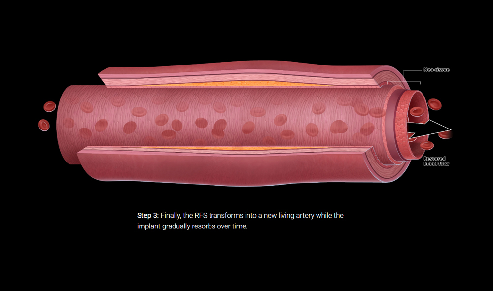 Artery blockage illustration for Stentit medical website design