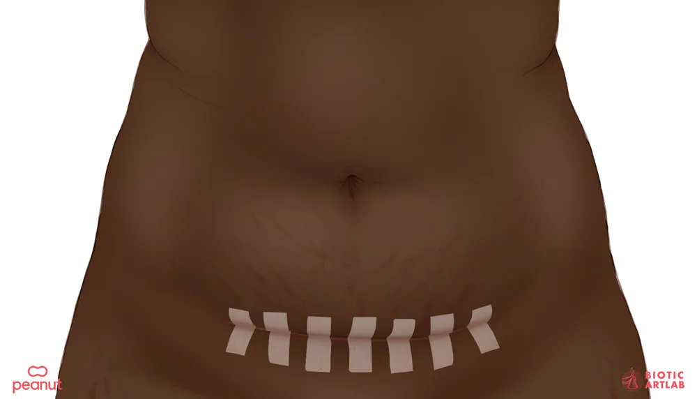 C-section scarring medical illustration for Peanut women's health app