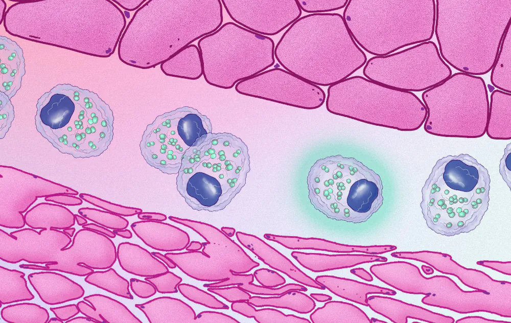 Cancer cachexia medical illustration showing metabolic muscle wasting