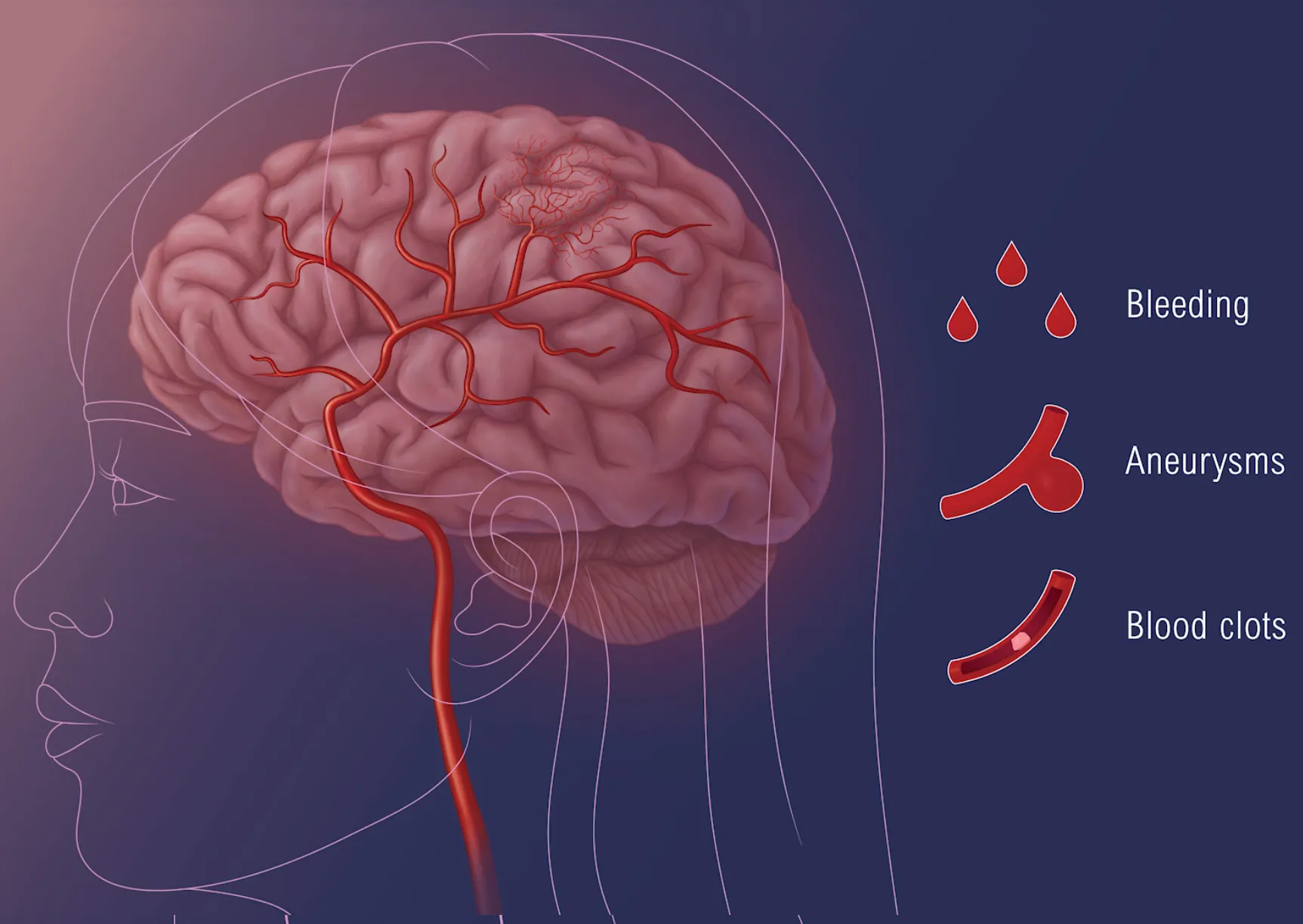 Moyamoya disease cerebrovascular illustration showing treatment options